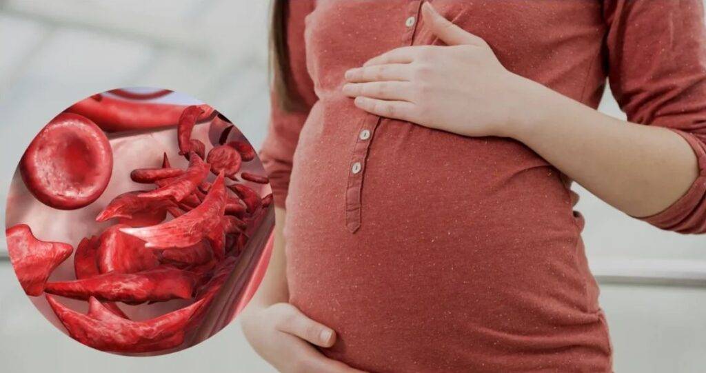 Sickle Cell Anemia During Pregnancy