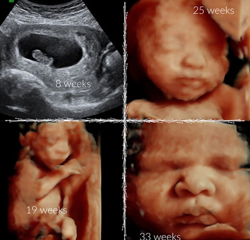 Collage of 8, 19, 25, and 33-week ultrasound images showing the development of the fetus from early stages to late pregnancy.